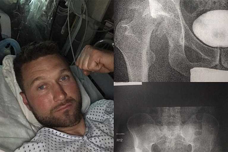 Smolis Hüfte und Oberschenkel wurden verschraubt