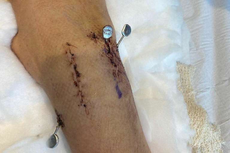 So sah das rechte Handgelenk von Dixon kurz nach dem Eingriff aus