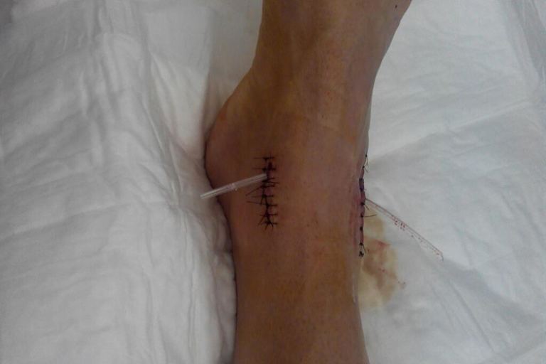 Marco Melandris Fuß kurz nach der Operation