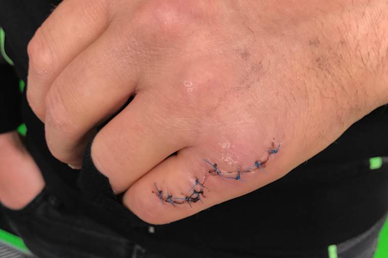 Der gebrochene Finger von Tom Sykes