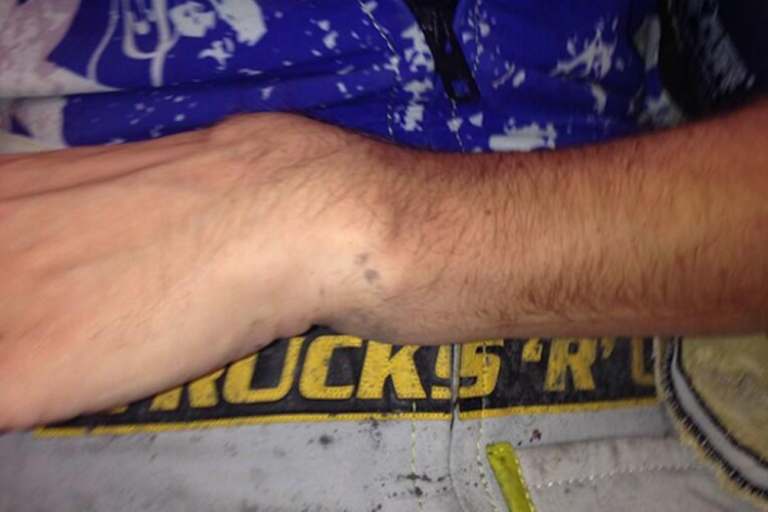 So sah Chris Holders Handgelenk vor der Operation aus