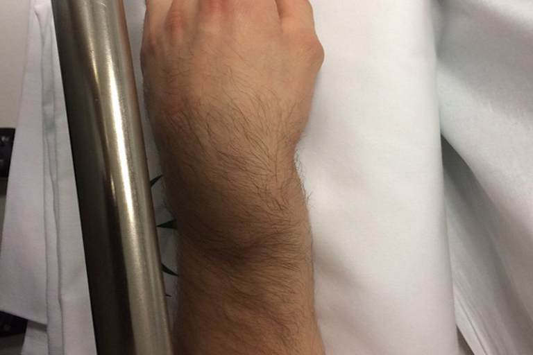 So sah Lavertys Unterarm nach dem Teststurz 2015 aus