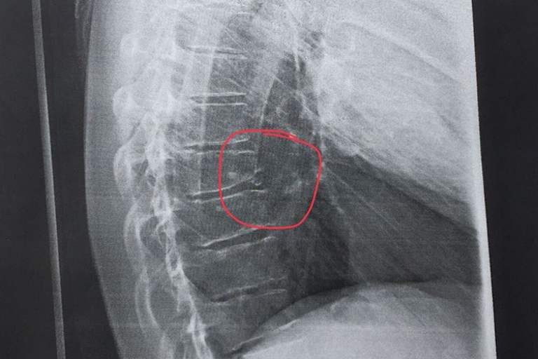 Smolinski erlitt eine Knochenabsplitterung an der Wirbelsäule