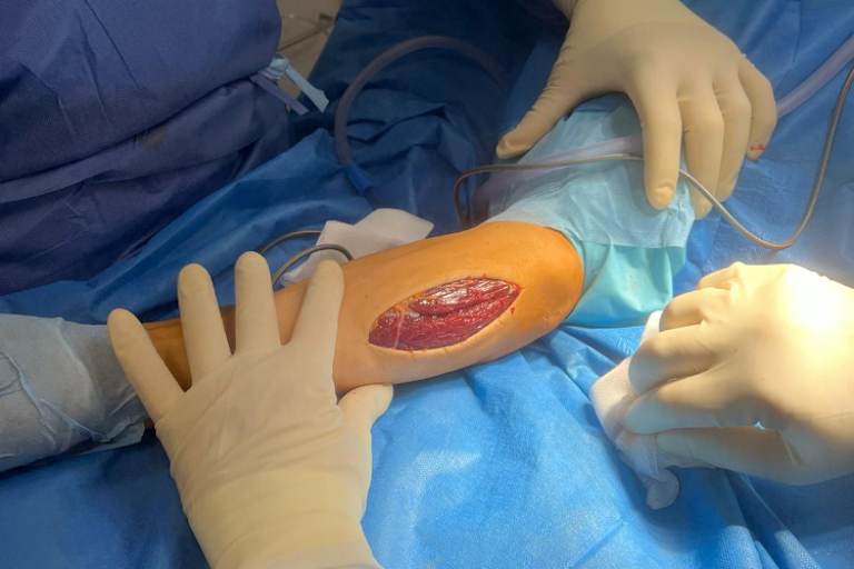 Die Faszien des Unterarms wurden aufgetrennt