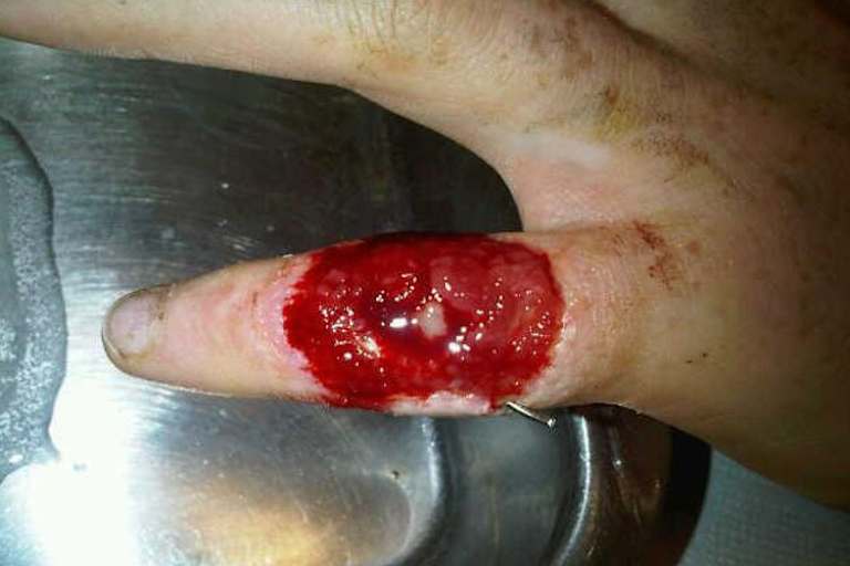 «Er sieht schon viel besser aus», meinte Smith auf Twitter. Der Draht wird heute entfernt